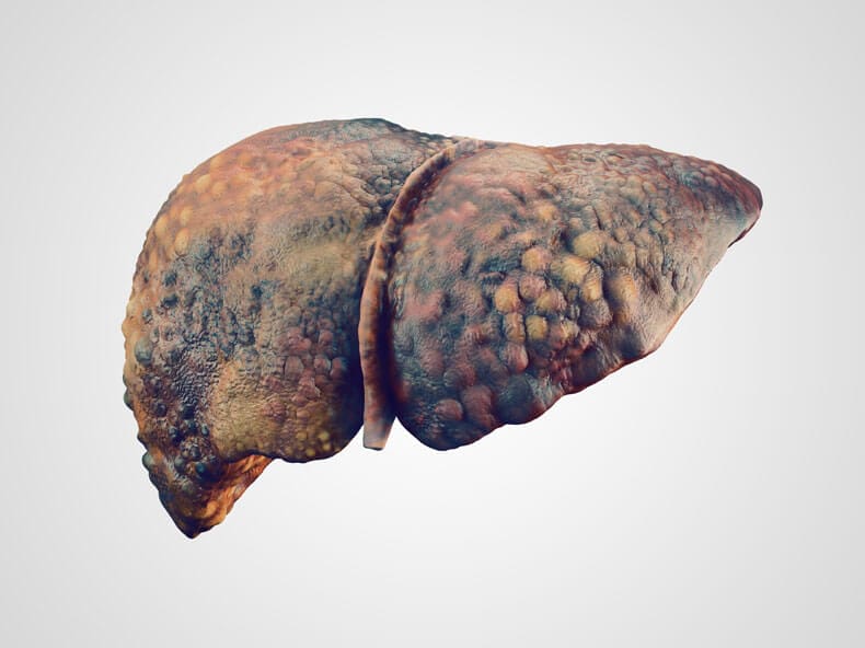 Alcoholic liver disease (ALD)