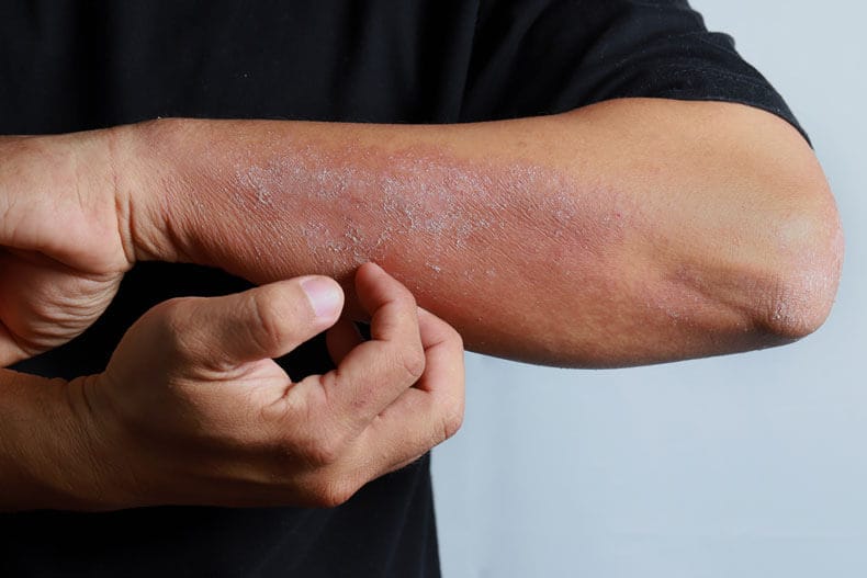 Eczema and Dermatitis