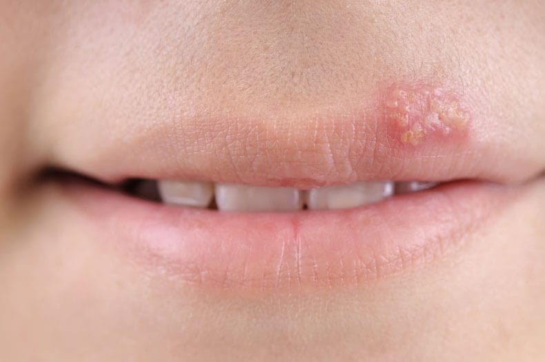 Herpes Simplex Virus