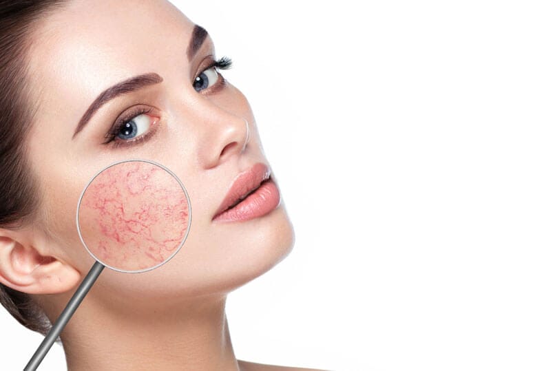Natural Rosacea Treatment