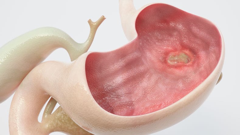Stomach Ulcer Treatment