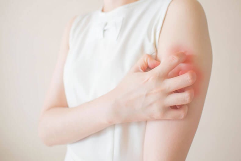 Urticaria / Hives