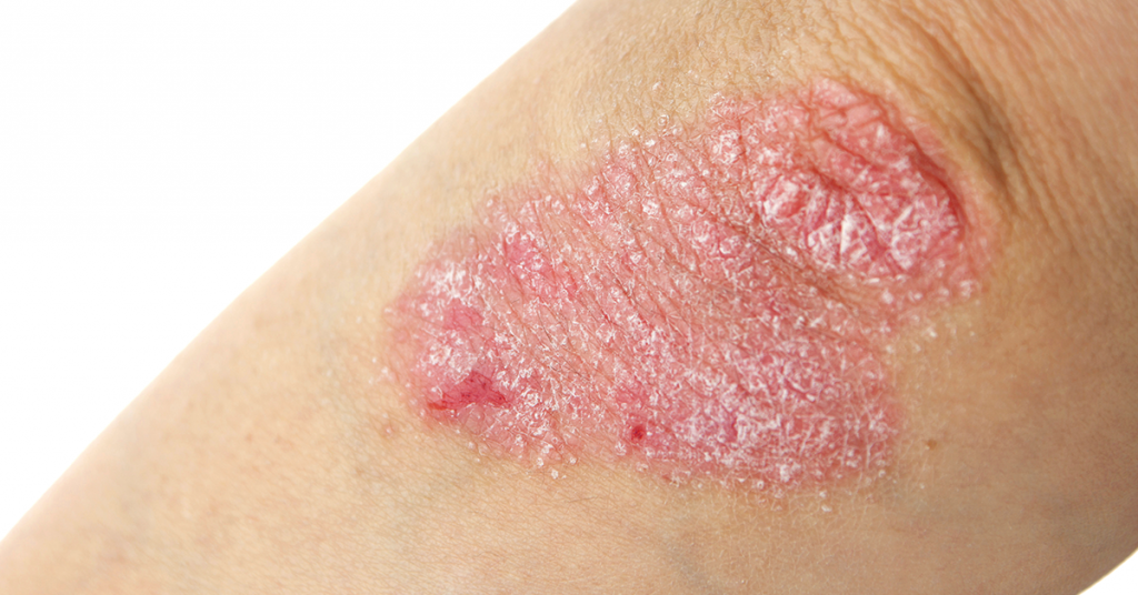 psoriasis and gut health